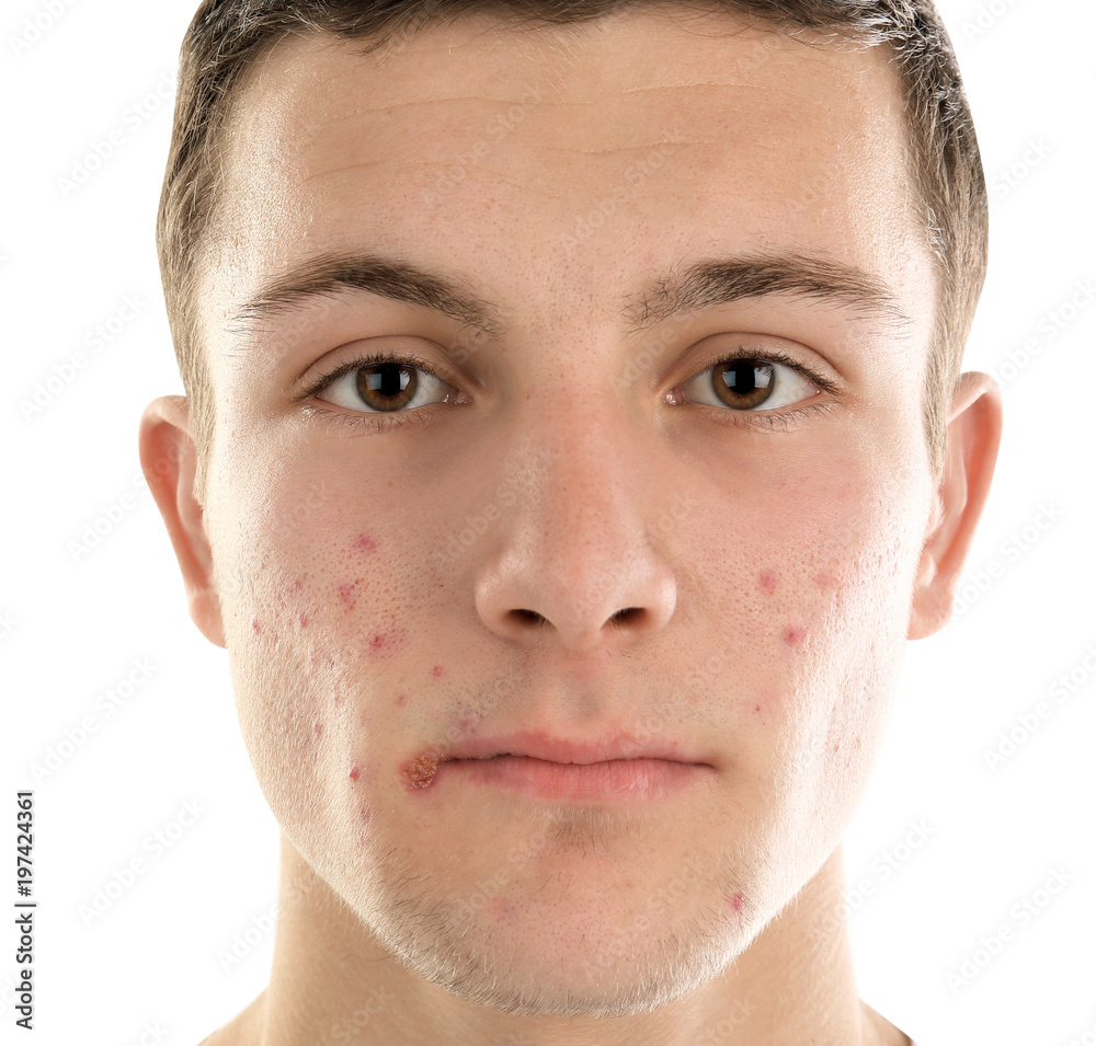 Acne Case