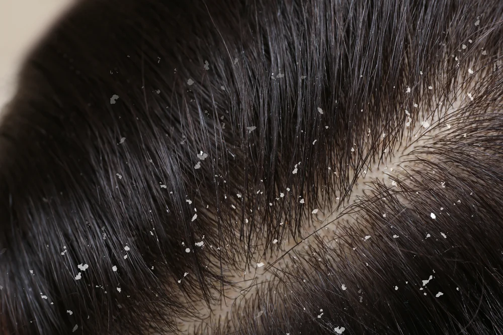 Scalp Case