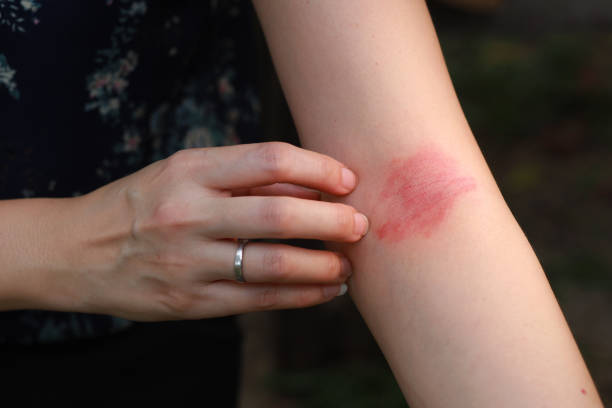 Skin Rash Case